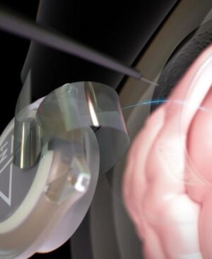 ACTUALITÉS TECH – Lors d’une interview, nous avons appris que douze patients avaient utilisé l’interface cerveau-ordinateur (BCI) pendant près de six ans au total.