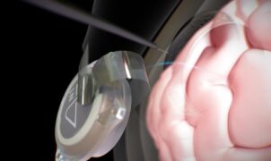 ACTUALITÉS TECH – Lors d’une interview, nous avons appris que douze patients avaient utilisé l’interface cerveau-ordinateur (BCI) pendant près de six ans au total.