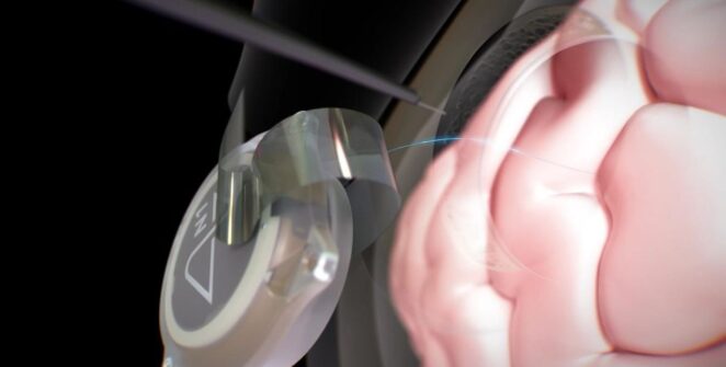ACTUALITÉS TECH – Lors d’une interview, nous avons appris que douze patients avaient utilisé l’interface cerveau-ordinateur (BCI) pendant près de six ans au total.
