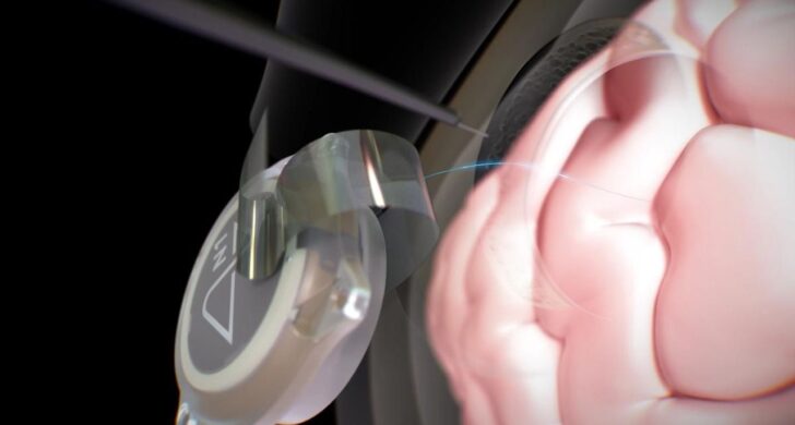 ACTUALITÉS TECH – Lors d’une interview, nous avons appris que douze patients avaient utilisé l’interface cerveau-ordinateur (BCI) pendant près de six ans au total.